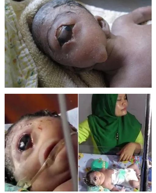 Couple who gave birth to Baby with One Eye and No nose (Cyclops baby)