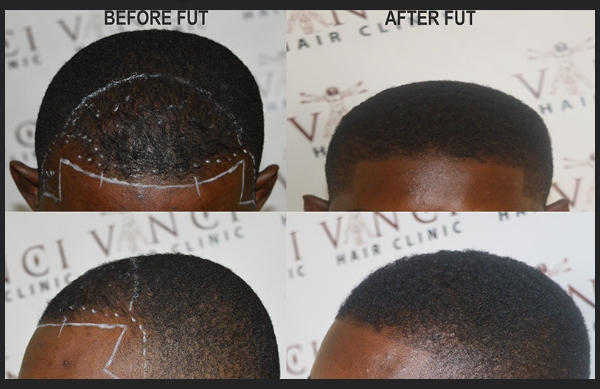 Hair Loss and Cost of Hair Transplant in Nigeria 2021 - 9JAINFORMED