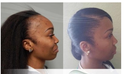 Cost of Hair Transplant in Nigeria 2021