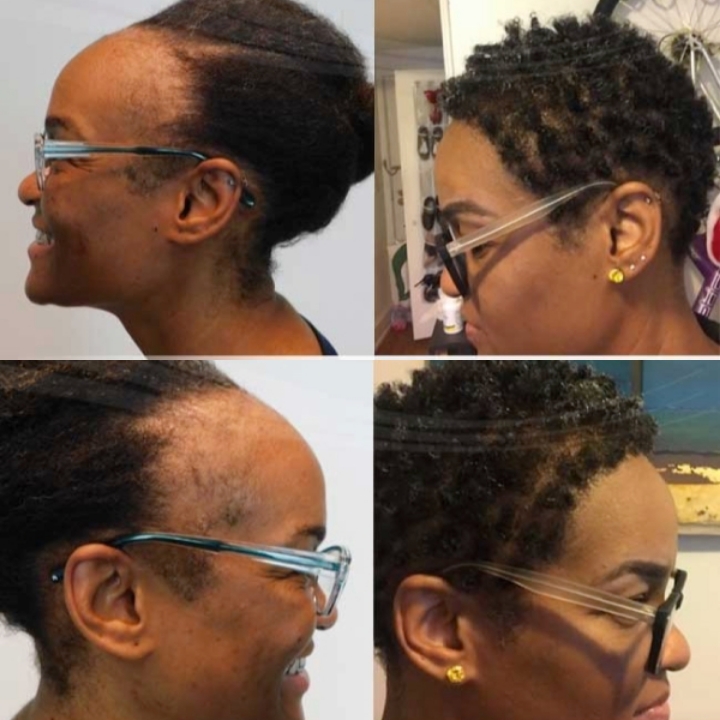 Hair Loss and Cost of Hair Transplant in Nigeria 2021 - 9JAINFORMED